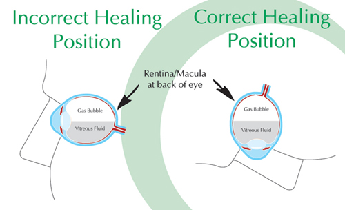 Healing Position